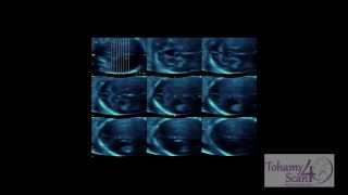 Autosomal Recessive Polycystic Kidney Disease (Potter Type I)