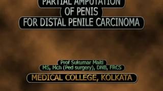 PARTIAL  PENECTOMY  FOR DISTAL PENILE CARCINOMA