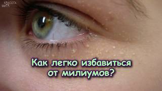 КАК ИЗБАВИТЬСЯ ОТ МИЛИУМОВ (белая сыпь, кисты на лице)?