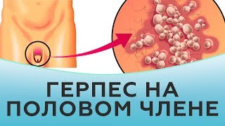 Герпес на половом члене