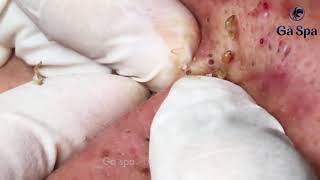 Blackheads: not popping but insertion!/Черноголовые угри: не давка, а вставка!