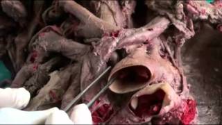 Trachea & bronchi