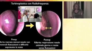 Respirare male dal naso: l'ipertrofia dei  turbinati (Dr. Isabelle Fini Storchi)