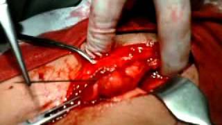 removing big needle from a young lady"s abdomen
