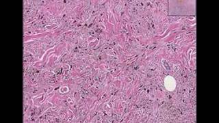 Histopathology Skin--Cellular Blue Nevus