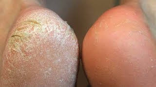 КОПЕЕЧНОЕ СРЕДСТВО от МОЗОЛЕЙ и НАТОПТЫШЕЙ