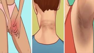 Descubre como eliminar las manchas de tu entrepierna cuello y axilas con efectivos métodos caseros