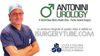 Dimostrazione protesi Peniena Idraulica tricomponente attivazione e disattivazione