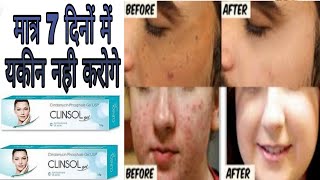 Clinsol Gel cream in hindi