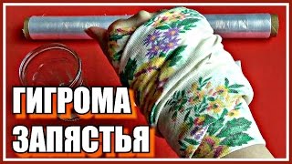 Мой УСПЕШНЫЙ ОПЫТ лечения гигромы ЗАПЯСТЬЯ.