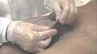 Lymphedema of External Genitalia