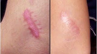 Sẹo lồi do mổ ruột thừa, ngã xe hay bỏng bô cũng bị “là phẳng” chỉ bằng loại rau chợ nào cũng bán