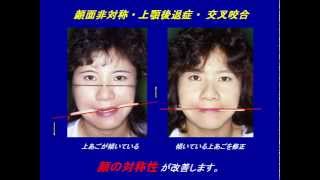 顎変形症の治療