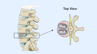 Have you been hurt by a Medtronic Infuse Bone Graft?