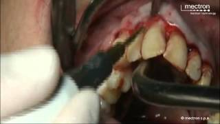 PIEZOSURGERY® - Root debridement by Dr. Marco Finotti
