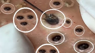 Cuidado de la piel facial más  satisfactorio #40 |Cómo limpiar el acné y el tratamiento del cliente