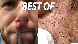 Best of Cysts, Blackheads, Comedones and Dermatology!