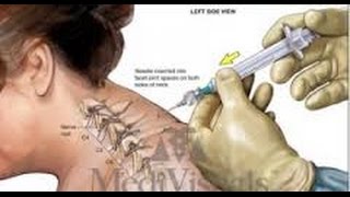 Neck Pain - Chiropractic Vs. Injections | Chiropractor Mechanicsville & Richmond VA
