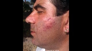 Ѓорѓи Велјановски: Ме претепа болничкото обезбедување од прилепската болница !