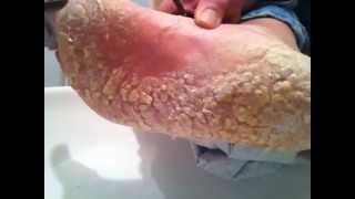 Dry cracked foot skin