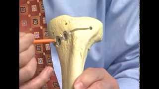 High Tibial Osteotomy - Dr. Douglas Wyland