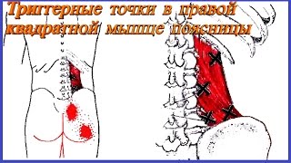 Боль в спине. Квадратная мышца поясницы. Миофасциальный синдром (триггерная точка).