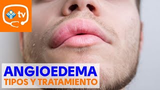 Angioedema: Tipos y tratamientos