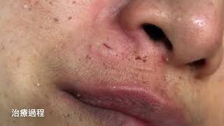 微創臉部/人中/鼻下粉瘤切除 傷口極小 美麗新城診所莊禮謙醫師 Minimal Incision, Epidermal Cyst, Philtrum, Dr George,