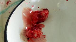 Open Prostatectomy/Как выглядит аденома простаты?