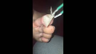 Foot Peel! Must Watch, feet like brand new!