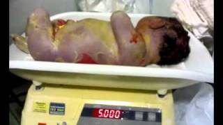 MACROSSOMIA FETAL
