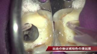 顕微鏡歯科　あずま歯科クリニック『痛い歯から膿を出す』