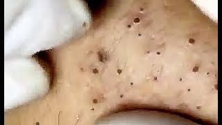 Amazing Blackheads... just wait for it