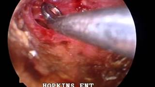 Endoscopic repositioning in management of Traumatic peroforations
