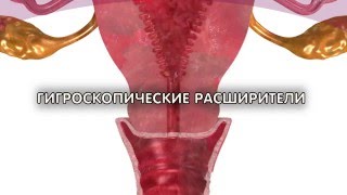 Дилапан-S безопасный расширитель шейки матки. Сравнение с палочками ламинарии