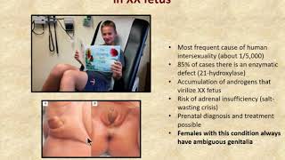Genital variations of development  the short story