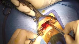 Rectocele repair