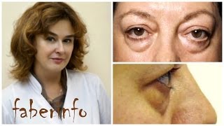 Убрать МЕШКИ под глазами БЕЗ РАЗРЕЗОВ. Подтяжка век. Блефаропластика.