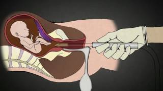 Abortion Procedure with Sopher Clamp Explained - 20 Weeks Gestation