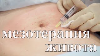 Как избавиться от растяжек после родов // Мезотерапия живота Часть 2