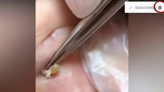 Nine Pimple Pops!  Tonsil Stones & Blackheads