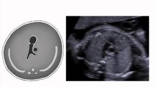Right Ventricular Outflow Tract View of the Fetal Heart