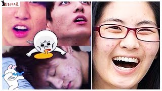 ? KPOP-idols VS Acne | Айдолы против Акне! ? | ToRi MaRtini