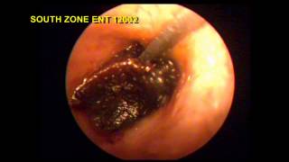 IMPACTED WAX REMOVAL WITH SPECIAL INSTRUMENT