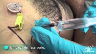 Maneja el port-a-cath.
