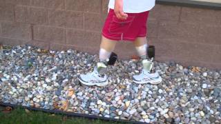 iWalk PowerFoot Biom bi-later below knee amputee