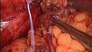 Fístula Vésico-vaginal gigante- Tratamento Laparoscópico