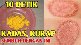 SEMUA PENYAKIT KULIT GATAL MENAHUN, KADAS & KURAP SEMBUH DENGAN INI