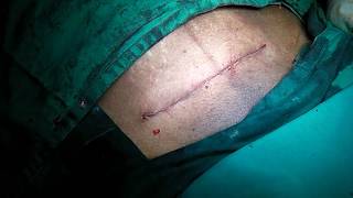 Caesarean Section