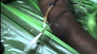 Urodynamic